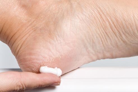 脚后跟干裂起硬皮是什么原因怎么治,这三个引发脚后跟干裂的原因