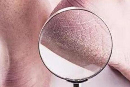 脚后跟干裂起硬皮是什么原因怎么治,这三个引发脚后跟干裂的原因