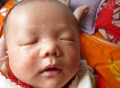 【新生儿湿疹】新生儿湿疹的症状_新生儿湿疹怎么办