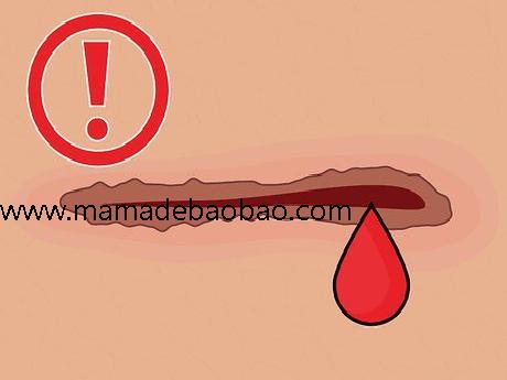 4种方法来去痂p站 - wikiHow（涂保湿霜）