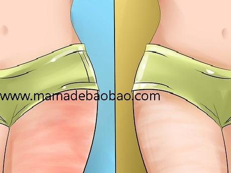 3种方法来遮住腿上的妊娠纹（使妊娠纹变浅）