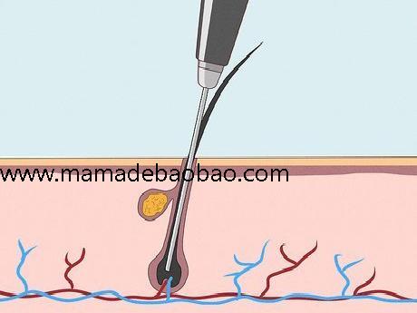 4种方法来不用剃刀也能去除男性阴毛（脱毛膏）